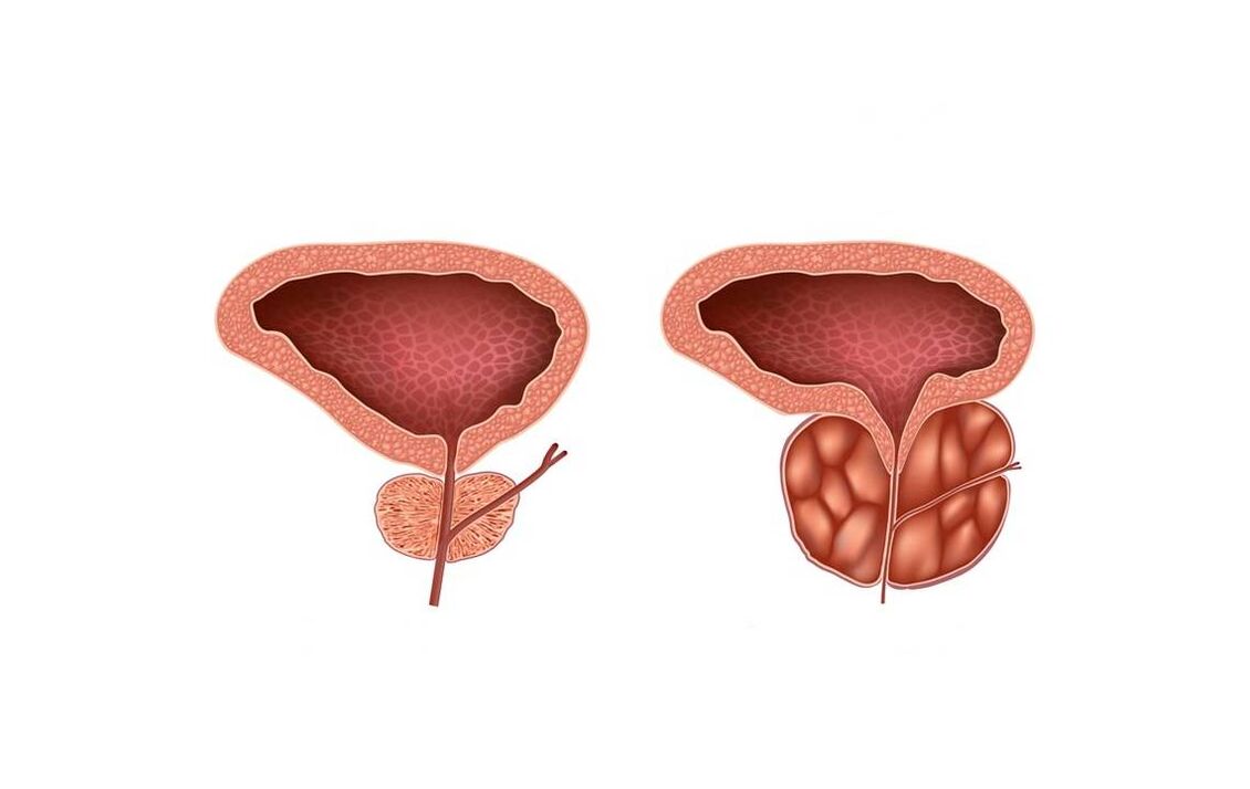 prostatitis symptoms in men
